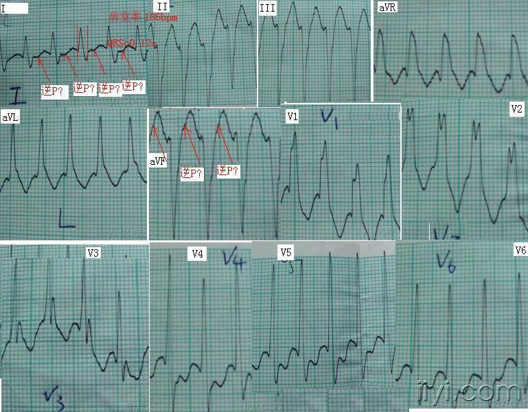 阵发性室上性心动过速(室上速)_室上性心动过速频繁发作怎么办_室上性心动过速怎么回事